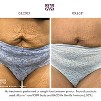 Alastin TransFORM Body Treatment