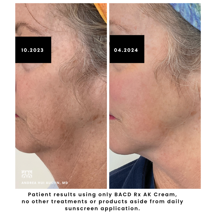 BACD Rx AK Cream