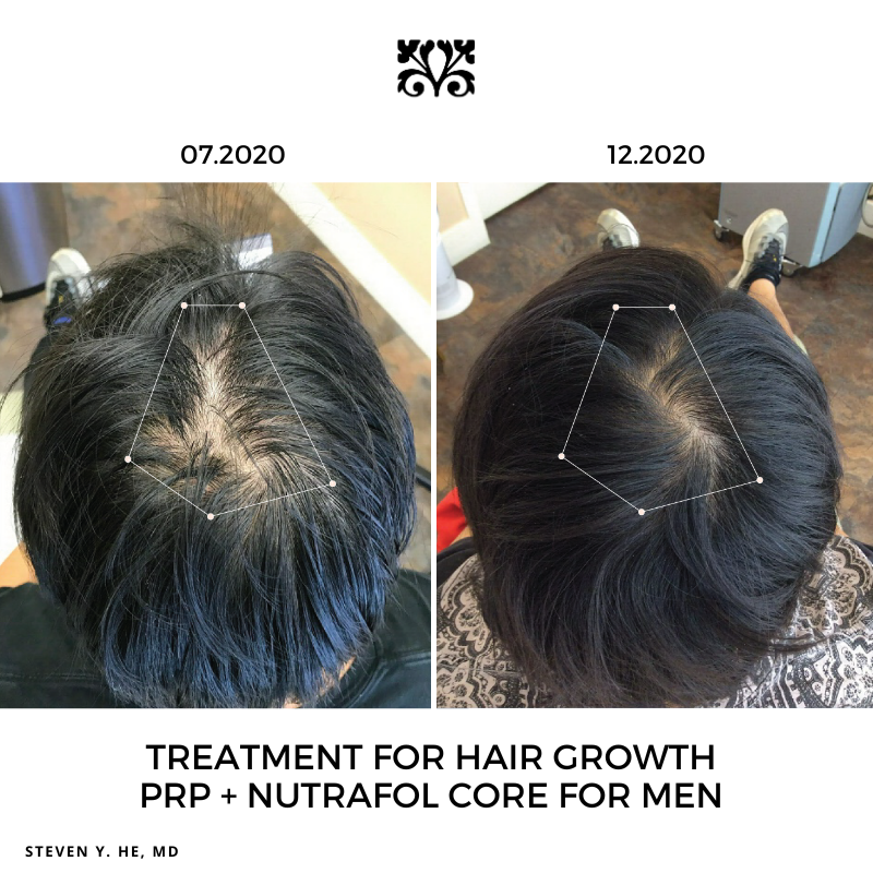 Nutrafol Men (3 Pack)